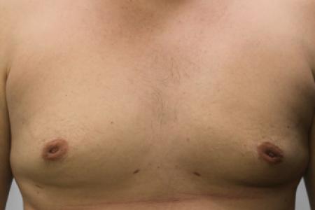 After image 1 Case #108141 - Gynecomastia