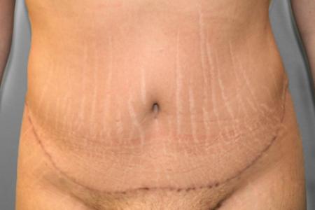 After image 1 Case #107676 - Tummy Tuck