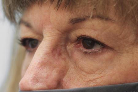 Before image 2 Case #107966 - Blepharoplasty