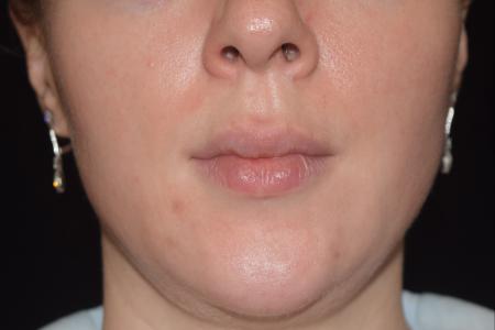 Before image 1 Case #108756 - Restylane Kysse Lip Enhancement