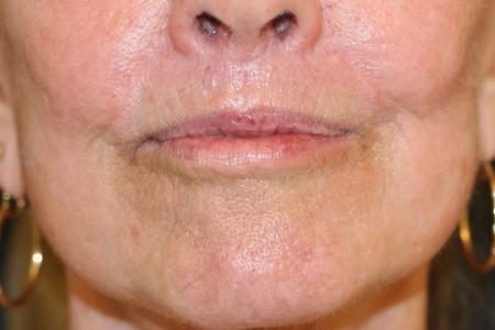 After image 1 Case #108821 - Upper Lip Lift + Corner Lip Lift