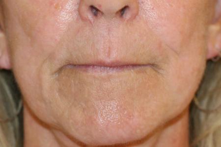 Before image 1 Case #108821 - Upper Lip Lift + Corner Lip Lift