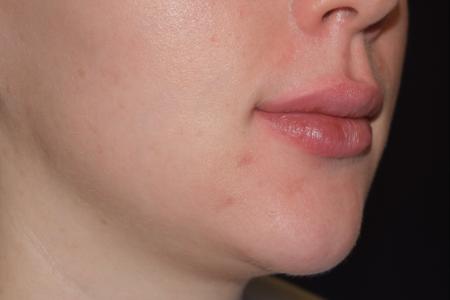 After image 2 Case #108756 - Restylane Kysse Lip Enhancement
