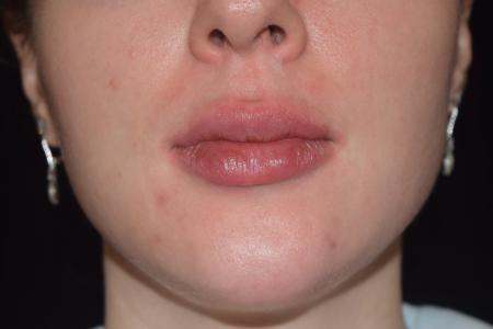 After image 1 Case #108756 - Restylane Kysse Lip Enhancement