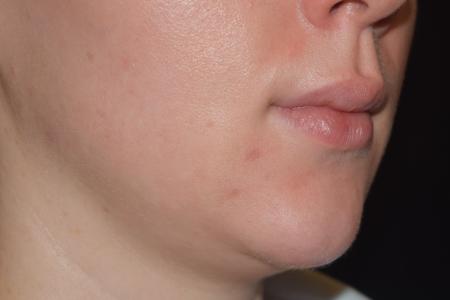 Before image 2 Case #108756 - Restylane Kysse Lip Enhancement