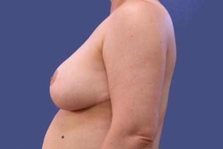After image 2 Case #109071 - Breast Reduction