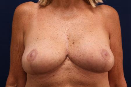 After image 1 Case #109121 - Implant Removal and Breast Lift