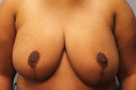 After image 1 Case #109176 - Breast Reduction