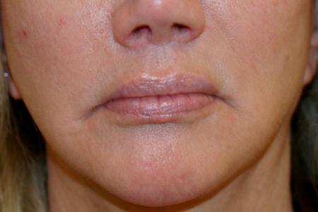 Before image 1 Case #109251 - Female Corner Lip Lift