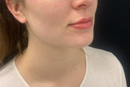 After image 2 Case #109391 - Restylane Kysse Lip Filler