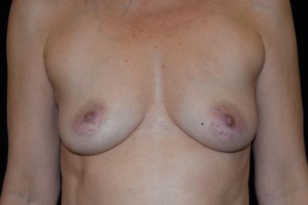 Before image 1 Case #109366 - Breast Augmentation