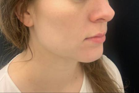 Before image 2 Case #109391 - Restylane Kysse Lip Filler