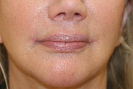 After image 1 Case #109251 - Female Corner Lip Lift