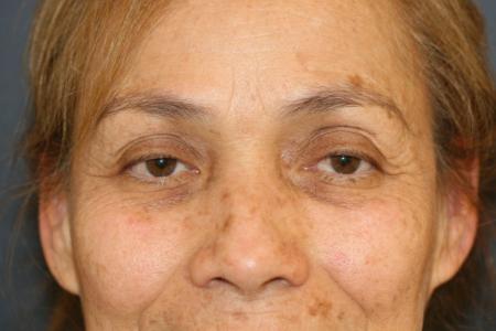 Before Case #109526 - Female Upper Eye Lift (Blepharoplasty)