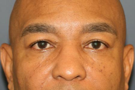 Before Case #109711 - Male Upper Blepharoplasty