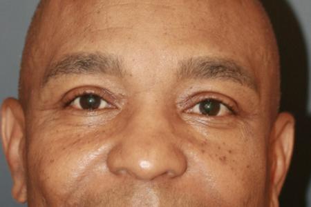 After Case #109711 - Male Upper Blepharoplasty