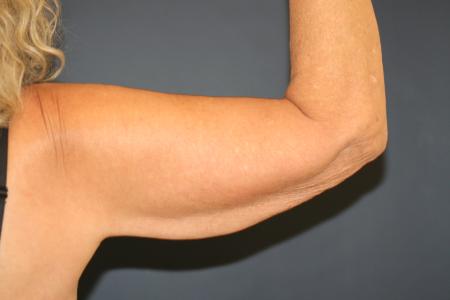 Before image 2 Case #109946 - Female Upper Arm Lift (Brachioplasty)