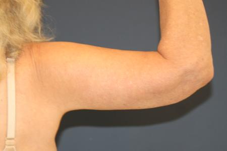 After image 2 Case #109946 - Female Upper Arm Lift (Brachioplasty)