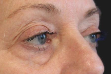 Before image 2 Case #109821 - 61 year-old female eye rejuvenation