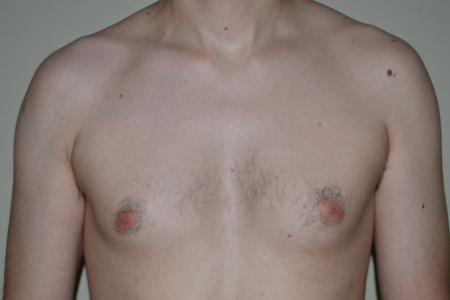 Before image 1 Case #109976 - Gynecomastia  Surgery