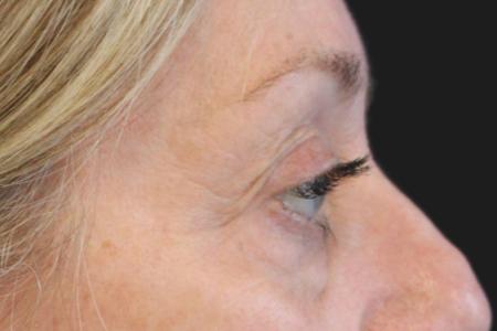 Before image 3 Case #109821 - 61 year-old female eye rejuvenation
