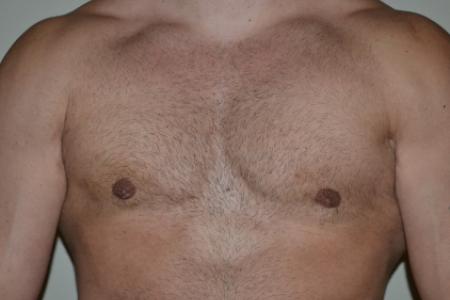 After image 1 Case #109991 - Gynecomastia and VASER liposuction of chest