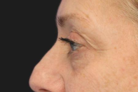 Before image 5 Case #109821 - 61 year-old female eye rejuvenation