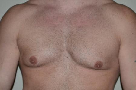 Before image 1 Case #109991 - Gynecomastia and VASER liposuction of chest
