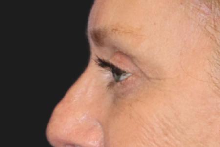 After image 5 Case #109821 - 61 year-old female eye rejuvenation