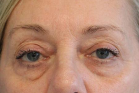 Before image 1 Case #109821 - 61 year-old female eye rejuvenation