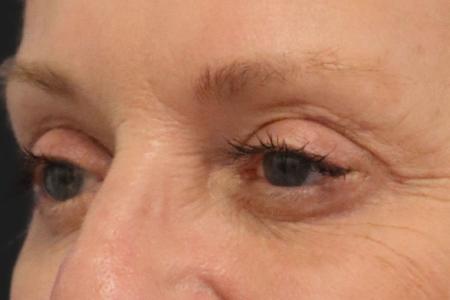 After image 4 Case #109821 - 61 year-old female eye rejuvenation