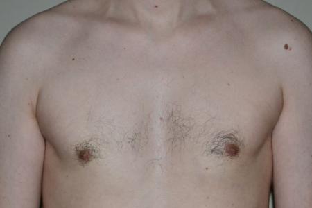 After image 1 Case #109976 - Gynecomastia  Surgery