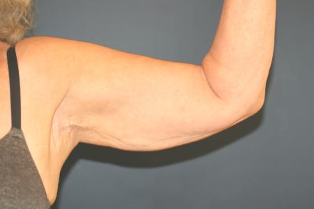 Before image 1 Case #109946 - Female Upper Arm Lift (Brachioplasty)