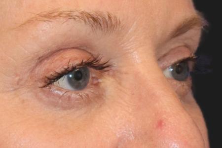 After image 2 Case #109821 - 61 year-old female eye rejuvenation