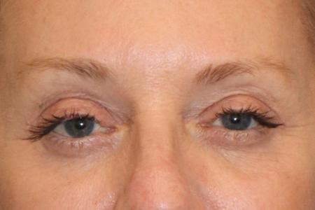 After image 1 Case #109821 - 61 year-old female eye rejuvenation