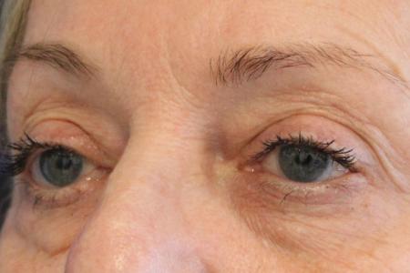 Before image 4 Case #109821 - 61 year-old female eye rejuvenation