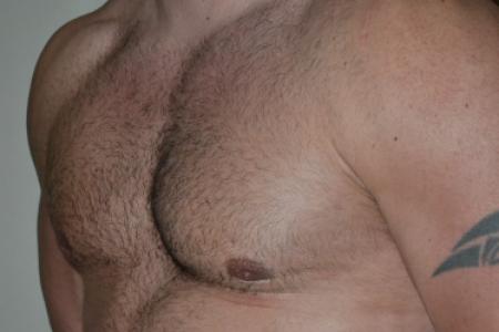 After image 2 Case #109991 - Gynecomastia and VASER liposuction of chest