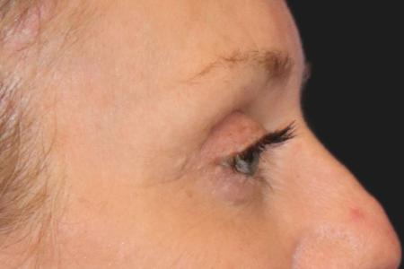 After image 3 Case #109821 - 61 year-old female eye rejuvenation