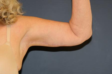 After image 1 Case #109946 - Female Upper Arm Lift (Brachioplasty)