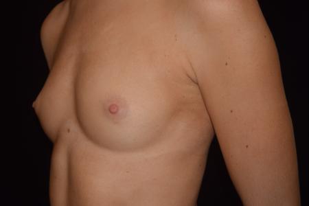 Before image 2 Case #110161 - Endoscopic Breast Augmentation (255cc)