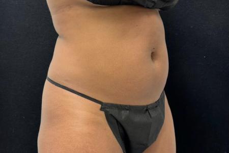 Before image 3 Case #110156 - CoolSculpting Elite (Two Sessions)
