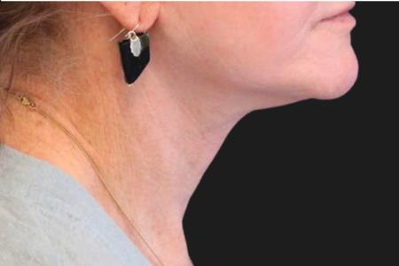 After image 3 Case #111861 - 70 year-old facial rejuvenation