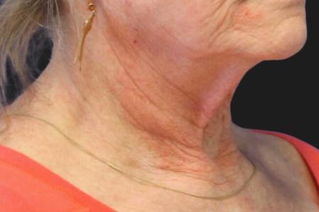 Before image 4 Case #111861 - 70 year-old facial rejuvenation