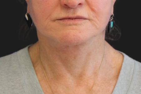 After image 1 Case #111861 - 70 year-old facial rejuvenation
