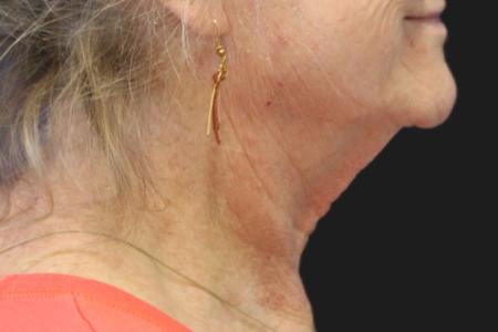 Before image 3 Case #111861 - 70 year-old facial rejuvenation
