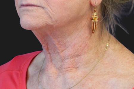 Before image 2 Case #111861 - 70 year-old facial rejuvenation