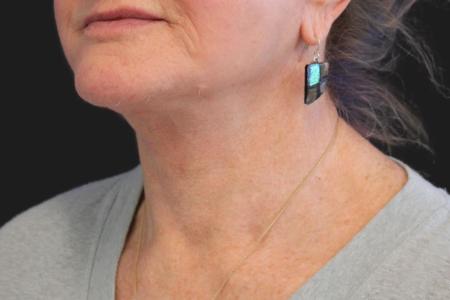 After image 2 Case #111861 - 70 year-old facial rejuvenation