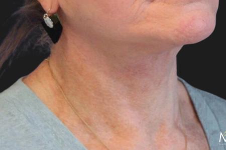 After image 4 Case #111861 - 70 year-old facial rejuvenation