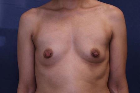 Before image 1 Case #112066 - Breast Augmentation