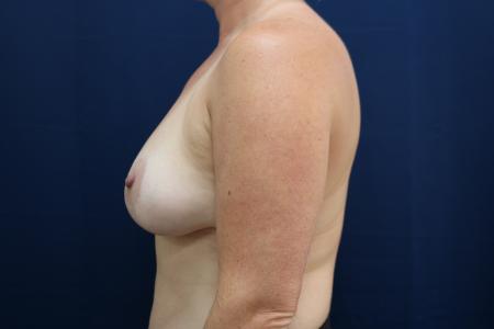 After image 3 Case #112106 - Breast Lift